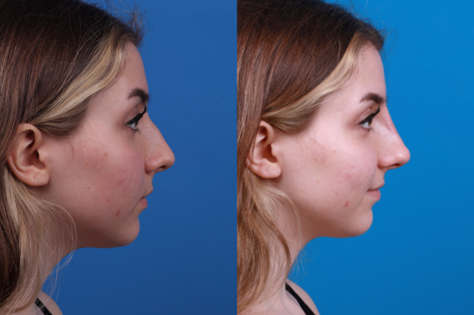 Liquid Rhinoplasty Photos Melbourne Fl Patient 32898